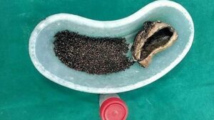 obat batu empedu