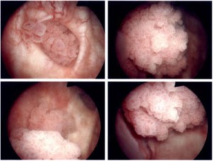 Tumor Kantung Kemih